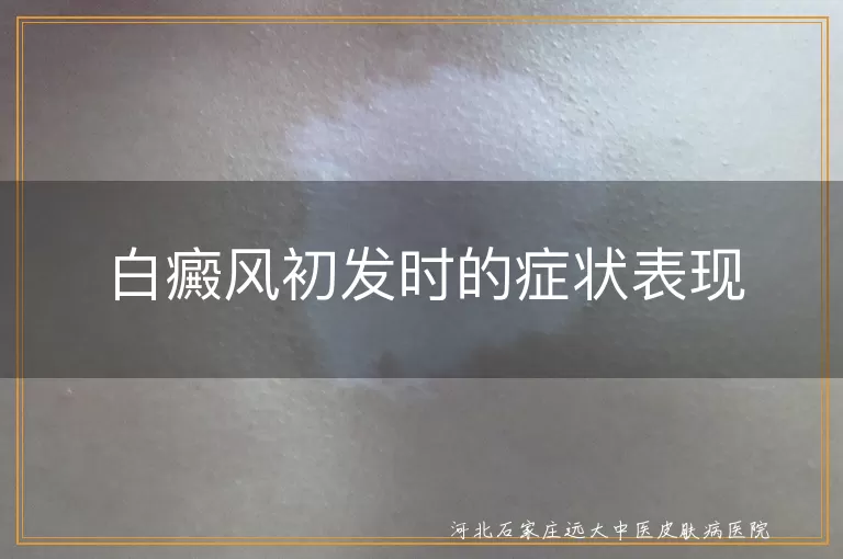 白癜风,白斑,毛发变白,皮肤感觉异常,对阳光敏感,初期症状