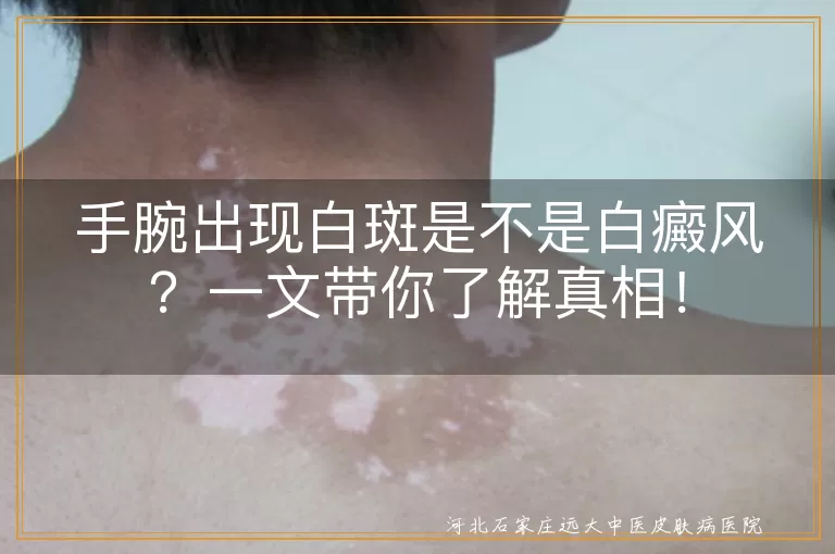 手腕白斑,白癜风,色素减退,皮肤病,诊断,治疗