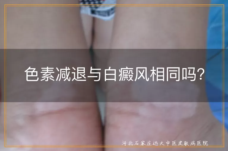 色素减退,白癜风,发病原因,症状表现,治疗方式,预后效果,及时就医,生活习惯,心态