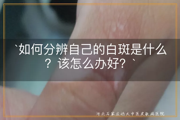 白斑,分辨,皮肤病,白癜风,花斑癣,贫血痣,无色素痣,炎症后色素减退,观察,治疗,护理