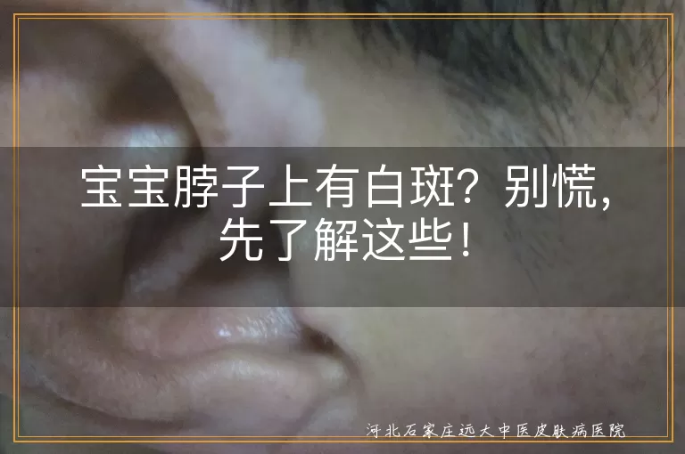 宝宝,白斑,无色素痣,白色糠疹,花斑癣,白癜风,预防,治疗,心态