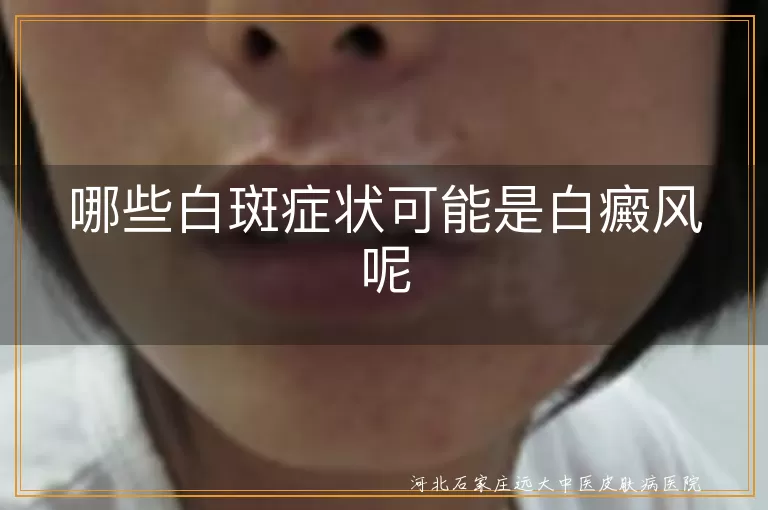 白癜风,白斑,乳白色,瓷白色,边缘清晰,表面光滑,扩散,毛发变白,专业检查
