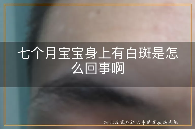 七个月宝宝,白斑,白色糠疹,白癜风,色素异常,就医检查,遵医嘱治疗,日常护理