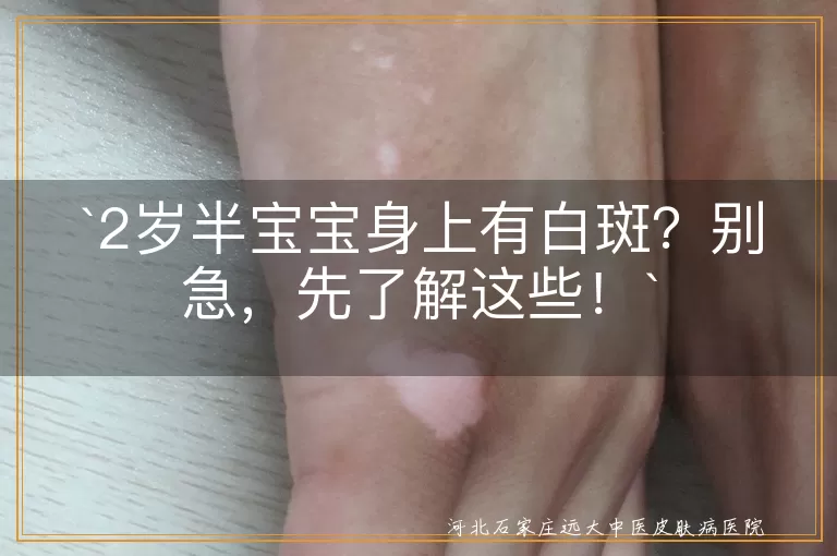 `2岁半宝宝,白斑,白色糠疹,无色素痣,贫血痣,白癜风,应对措施,预防小贴士`