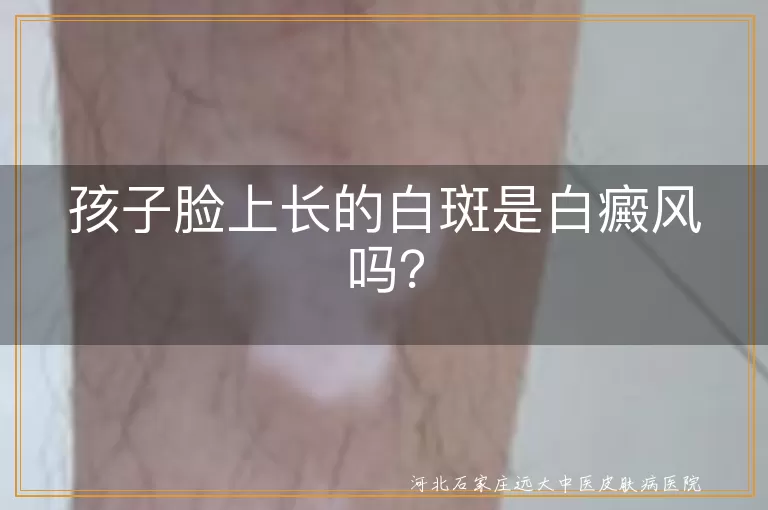 白斑,白癜风,白色糠疹,花斑癣,无色素痣,贫血痣,营养不良,专业检查,治疗方案,日常护理