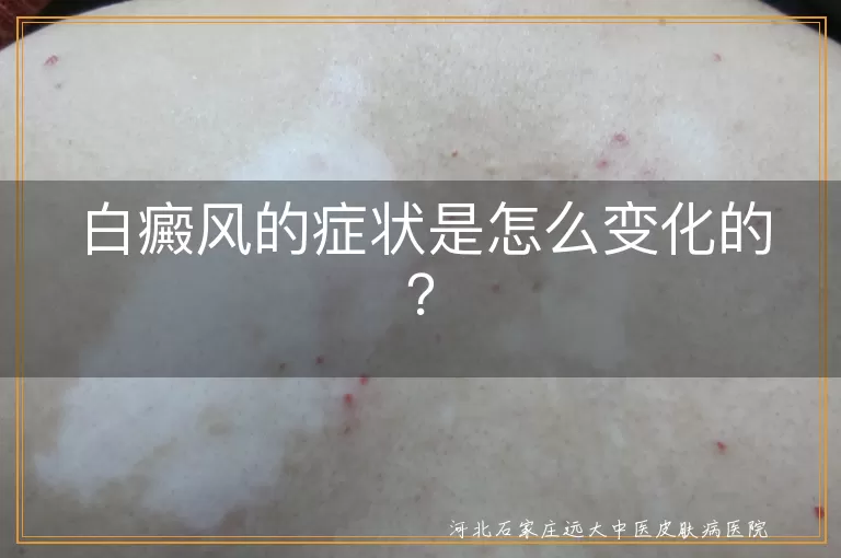 白癜风,症状,变化,初期,发展,稳定,反复,影响因素,应对方法