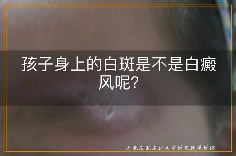 白斑,白癜风,儿童,无色素痣,贫血痣,白色糠疹,花斑癣,治疗,预防