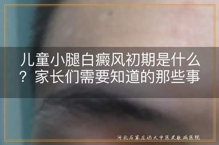儿童,小腿白癜风,初期症状,诊断,治疗,预防