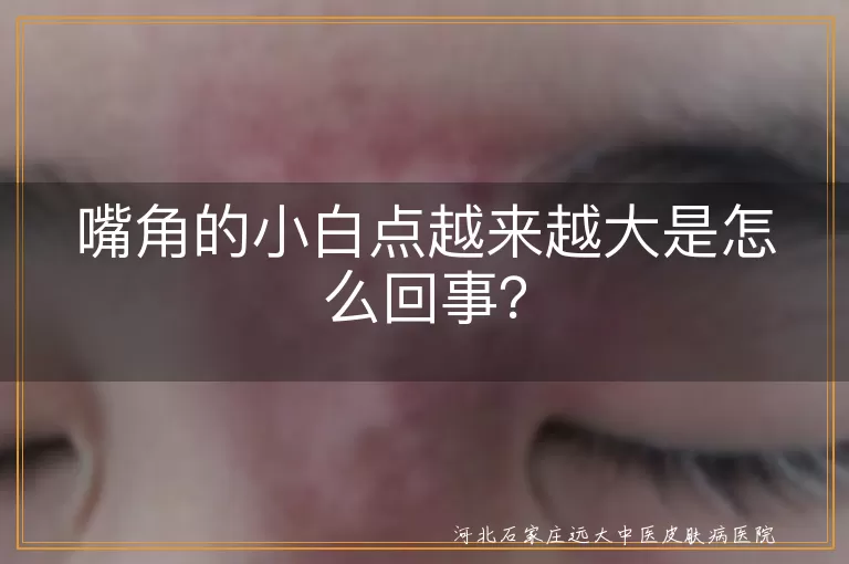 嘴角小白点,口角炎,皮脂腺异位症,白癜风,口唇疱疹,口腔念珠菌感染,病情发展,外部刺激,免疫力下降,心理压力,及时就医,生活习惯,营养均衡
