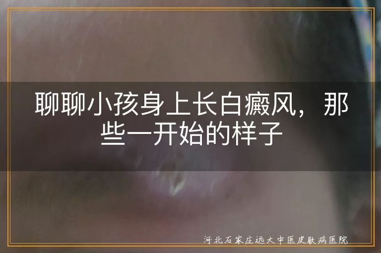 白癜风,小孩,最初症状,颜色浅,暴露部位,看医生,科学治疗,日常护理,防晒,饮食,心理支持