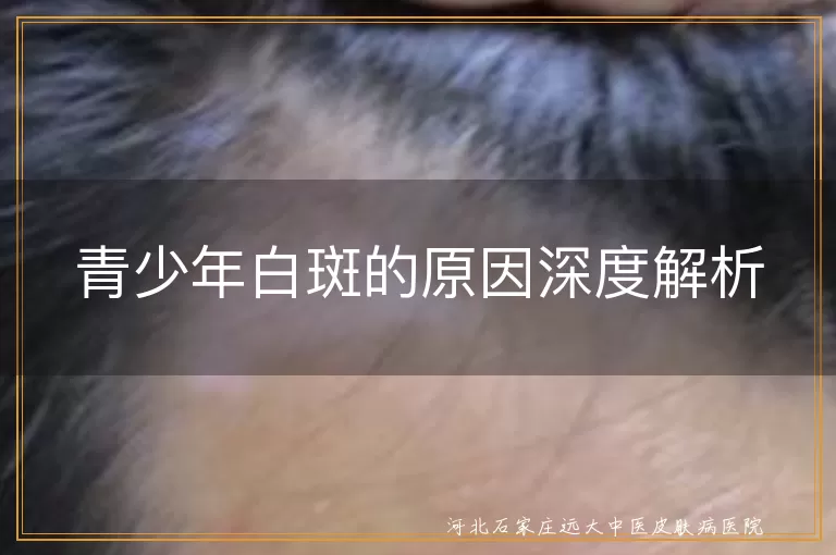 青少年白斑,遗传因素,免疫系统疾病,精神压力,营养不均衡,环境因素,皮肤疾病,治疗,心理调适