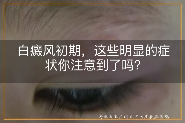 白癜风,初期症状,白斑,扩散,边缘清晰