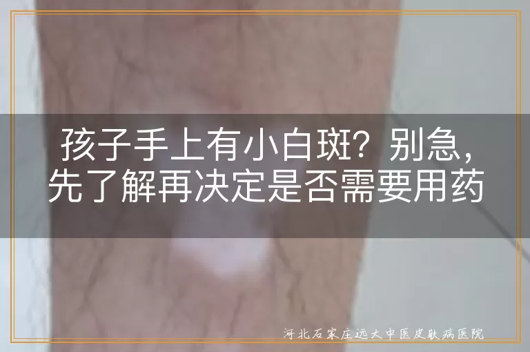 孩子,小白斑,无色素痣,白色糠疹,白癜风,花斑癣,就医,治疗,护理,营养均衡,防晒