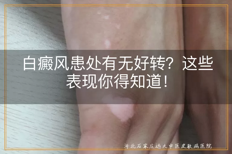 白癜风,患处好转,白斑颜色变淡,白斑面积缩小,色素沉着,皮肤感觉恢复,毛发颜色恢复,整体病情稳定