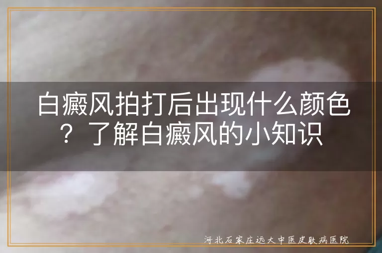 白癜风,拍打,变红,早期症状,确诊,治疗方法,生活习惯