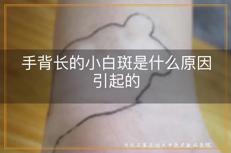 手背白斑,白癜风,营养不均衡,阳光暴晒,心理压力,皮肤疾病
