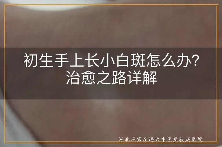 初生宝宝,小白斑,白癜风,治疗,日常护理,耐心坚持,心态积极