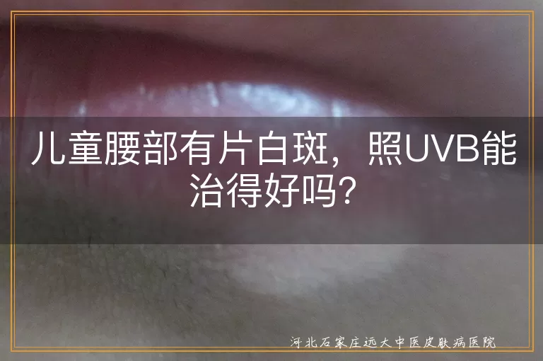 儿童腰部白斑,UVB光疗,白癜风,治疗效果,安全性,保护皮肤,皮肤保湿,避免化学物质接触