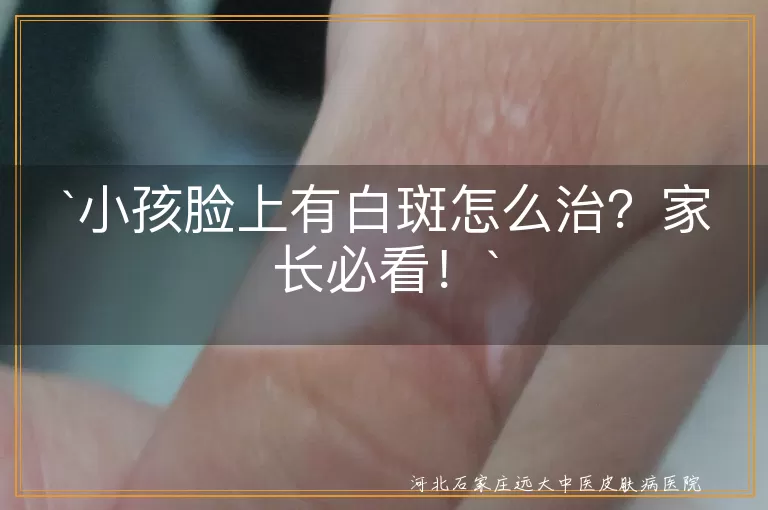 `小孩,脸上白斑,白色糠疹,白癜风,无色素痣,贫血痣,治疗,日常护理`