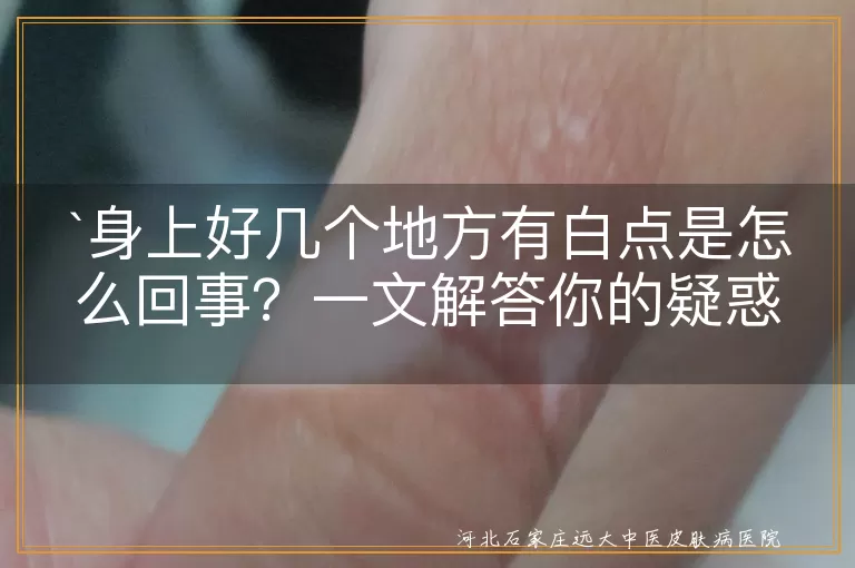 小白点,皮肤老化,色素减退,特发性点状白斑,白癜风,预防,治疗