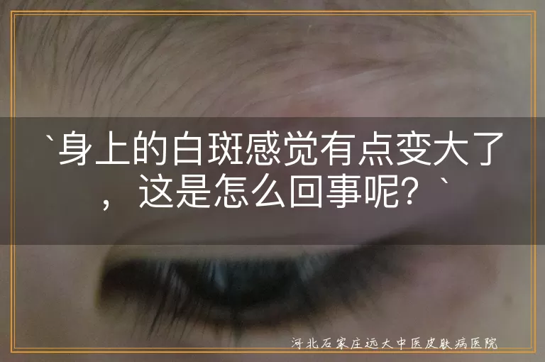白斑,变大,原因,遗传因素,免疫系统,环境因素,荷尔蒙变化,冷静,记录变化,避免刺激,饮食调整,寻求专业意见
