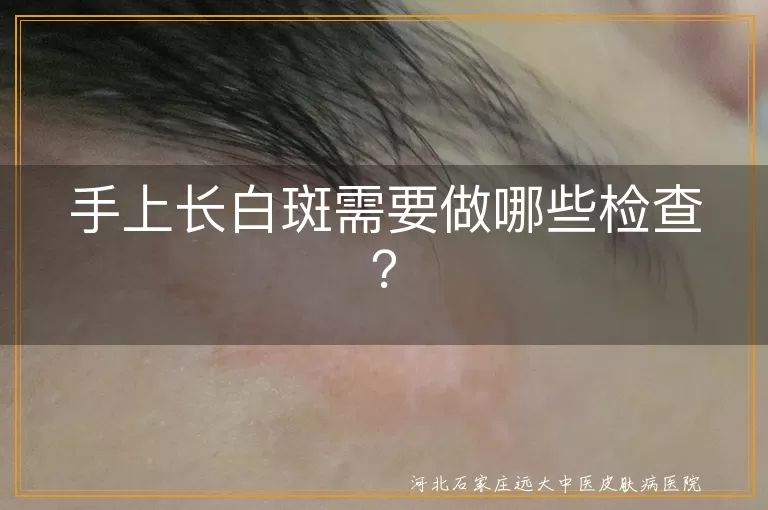 手上长白斑,血常规检查,皮肤镜检查,真菌检查,伍德灯检查,组织病理学检查,甲状腺功能测定,免疫功能检测