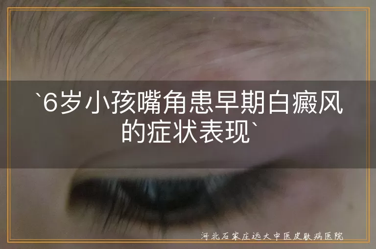 6岁小孩,嘴角,早期白癜风,淡白色斑块,形状不规则,毛发变白,防晒,心理关怀