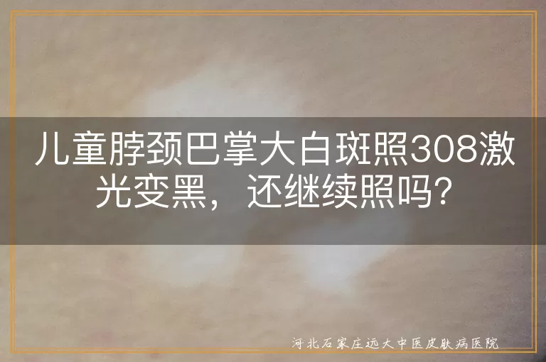 儿童白斑,308激光治疗,变黑,继续治疗,注意事项