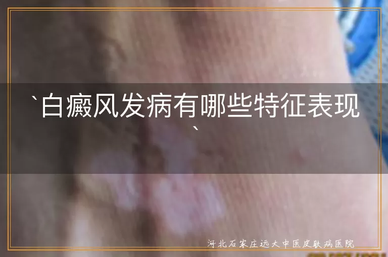 白癜风,白斑,扩散,毛发变白,日晒反应,心理压力