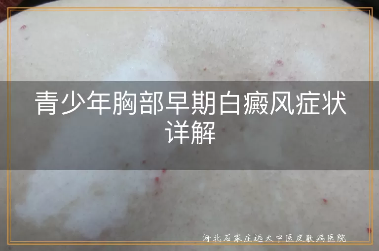 青少年,胸部,白癜风,早期症状,白斑,治疗,防晒,心态