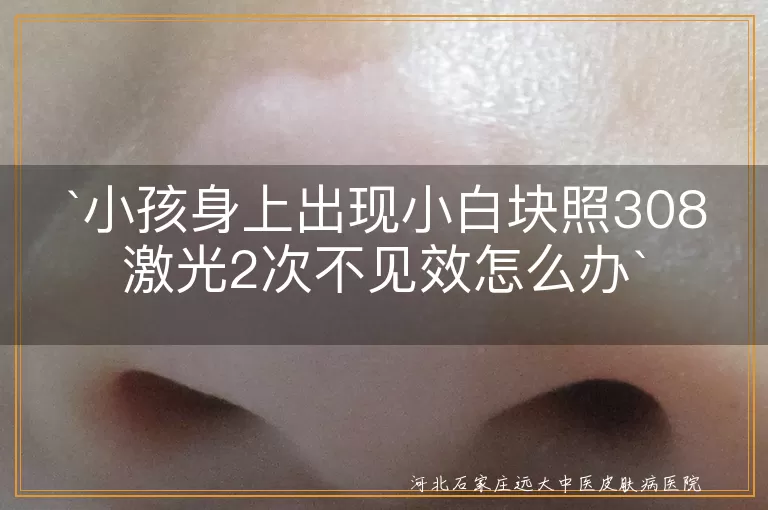 小孩,小白块,308激光,不见效,白癜风,治疗方案,坚持治疗,心理支持,正规医院