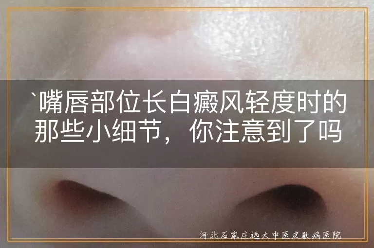 嘴唇部位长白癜风轻度时的那些小细节，你注意到了吗？