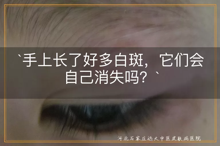 白斑,色素减退,暂时性白斑,持久性白斑,治疗,预防,皮肤保护