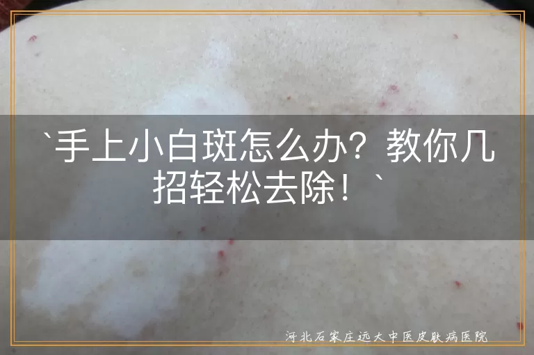 手上小白斑,去除方法,日常护理,激光治疗,药物治疗,中医调理,预防小贴士
