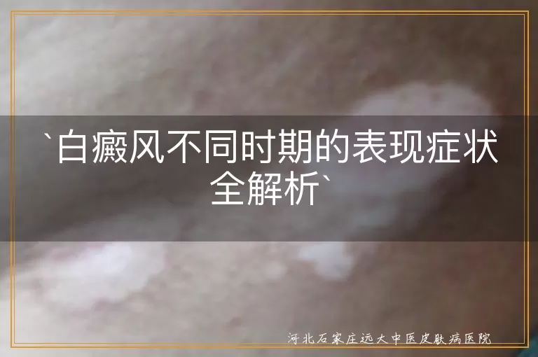 白癜风,初期症状,发展期症状,稳定期症状,晚期症状,白斑,皮肤变化,并发症