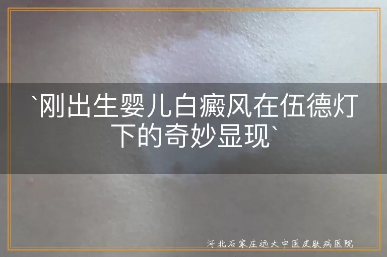伍德灯,白癜风,婴儿,皮肤,色素脱失,治疗,预防