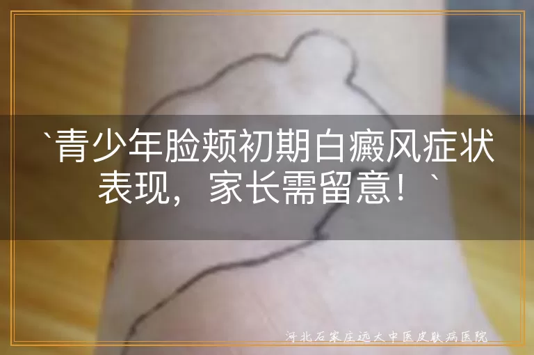 青少年,脸颊,白癜风,初期症状,白斑,预防,治疗