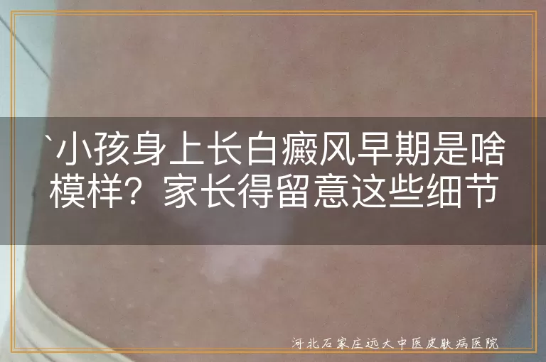 小孩白癜风,早期症状,白斑,颜色变化,边缘清晰,扩散,皮肤瘙痒,免疫力下降
