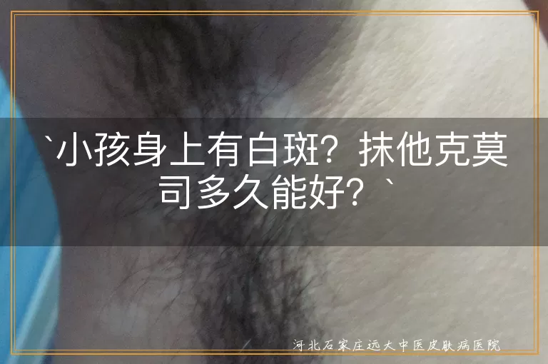 白斑,他克莫司软膏,治疗时间,防晒,饮食调整,心理疏导,白癜风