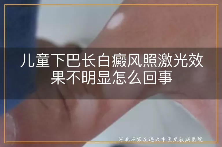 儿童白癜风,激光治疗,效果不明显,治疗时间,病情严重程度,个体差异,综合治疗,日常护理