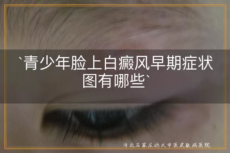 青少年,白癜风,早期症状,白斑,扩散,皮肤敏感,头发变白,科学治疗