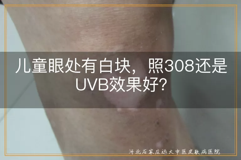 儿童眼处白块,308激光,UVB光疗,安全性,治疗效果,适用人群,费用考虑,日常生活注意事项