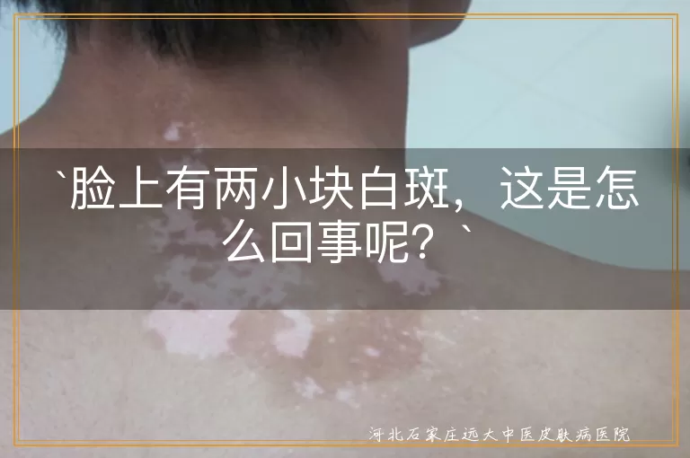 脸上白斑,色素减退斑,白癜风,贫血痣,无色素痣,遗传因素,环境因素,身体状态,科学治疗
