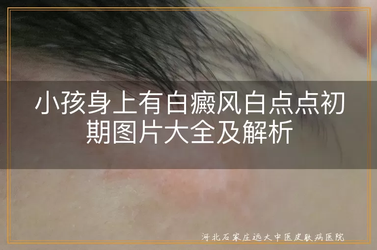 白癜风,小孩,初期症状,白斑,图片,治疗,白色糠疹,贫血痣,汗斑