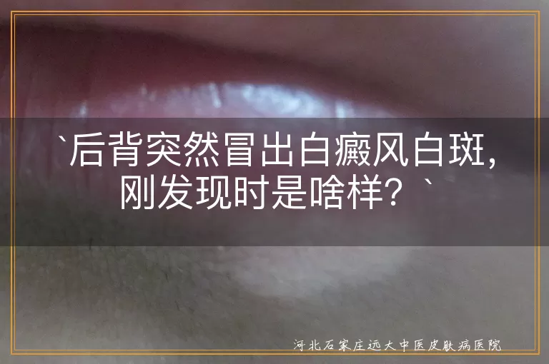 白癜风,白斑,皮肤异常,边缘清晰,表面光滑,积极治疗