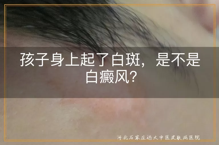 白斑,白癜风,白色糠疹,花斑癣,贫血痣,无色素痣,就医,诊断,预防