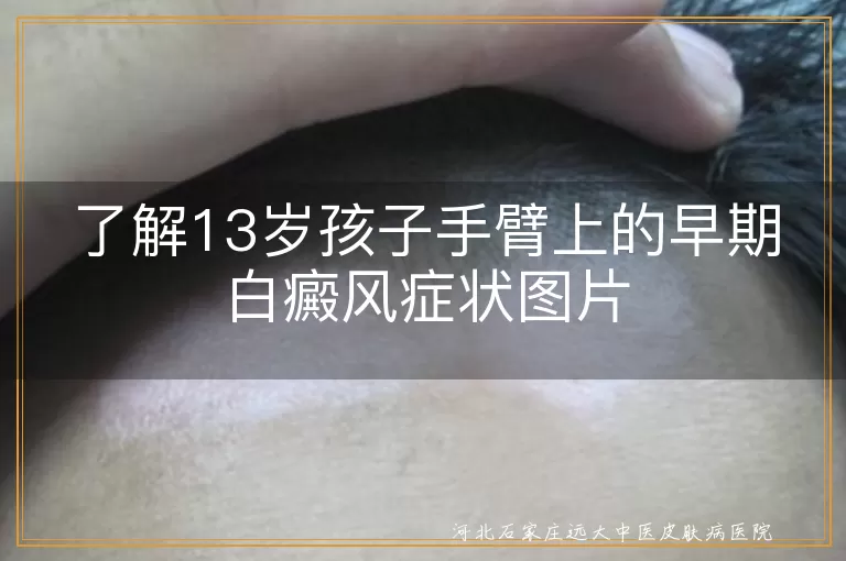 13岁孩子,手臂,早期白癜风,症状,图片,轻微色素减退斑,白斑数量,毛发颜色变化,局部皮肤感觉异常