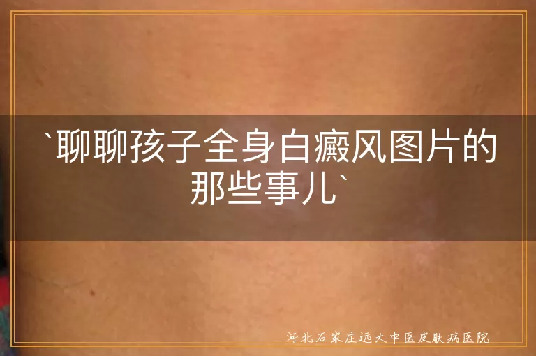 孩子,全身白癜风,图片,治疗,心理健康,家长,乐观坚持