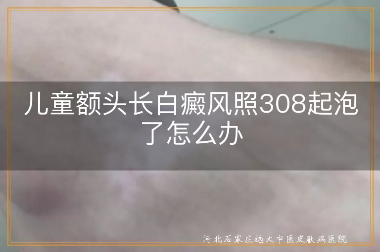 儿童白癜风,308激光,水泡处理,日常护理,医生沟通,心理健康