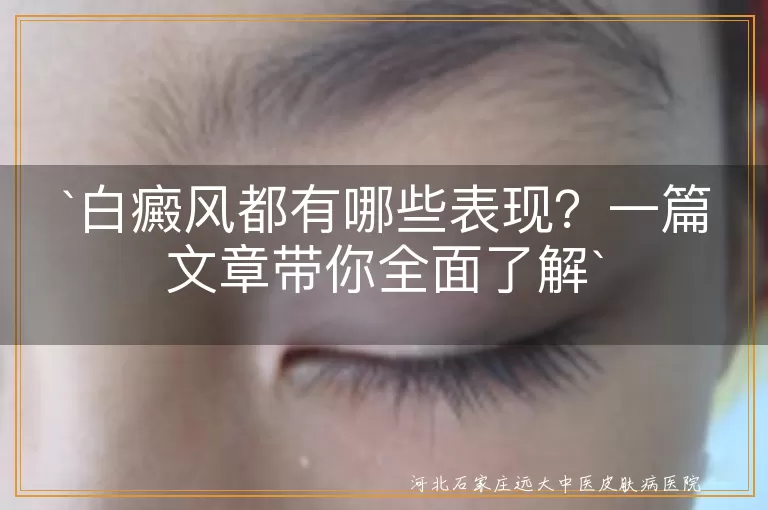 白癜风,白斑,黑色素细胞,形状各异,大小不一,颜色深浅不一,伴随症状,发展过程